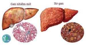 gan nhiem mo 1