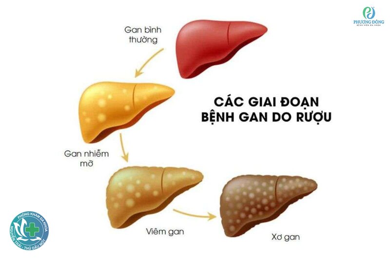 Gan nhiễm mỡ - Gan nhiễm mỡ gồm những dạng nào? Gan nhiễm mỡ - Gan nhiễm mỡ gồm những dạng nào?