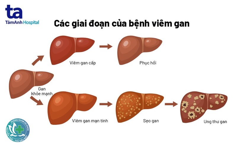 Gan nhiễm mỡ - Chẩn đoán gan nhiễm mỡ như thế nào? Gan nhiễm mỡ - Chẩn đoán gan nhiễm mỡ như thế nào?