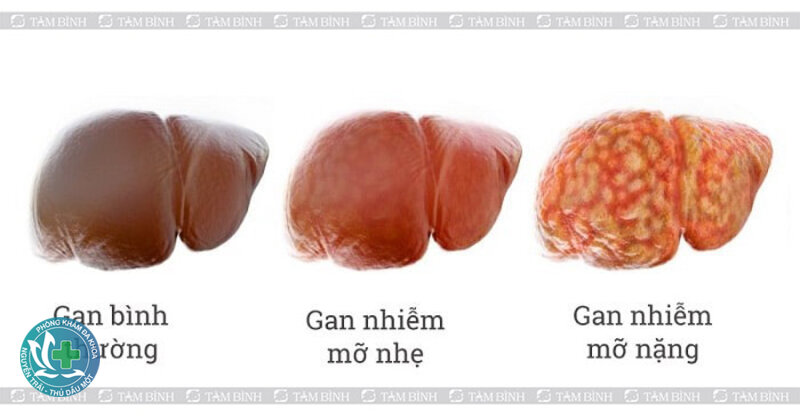 Gan nhiễm mỡ - Vai trò của thuốc Gan nhiễm mỡ - Vai trò của thuốc