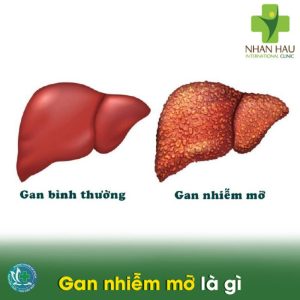gan nhiem mo co nguy hiem khong 1