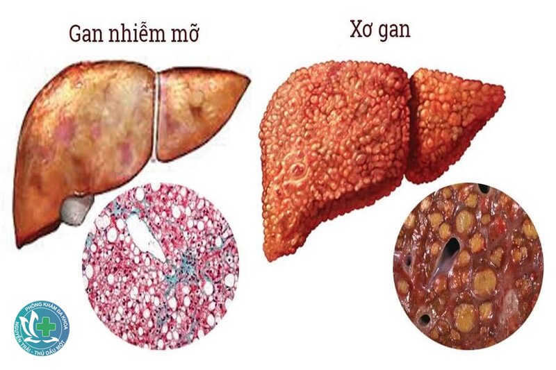 Gan nhiễm mỡ có nguy hiểm không - Vì sao có người nhẹ, người lại tiến triển? Gan nhiễm mỡ có nguy hiểm không - Vì sao có người nhẹ, người lại tiến triển?