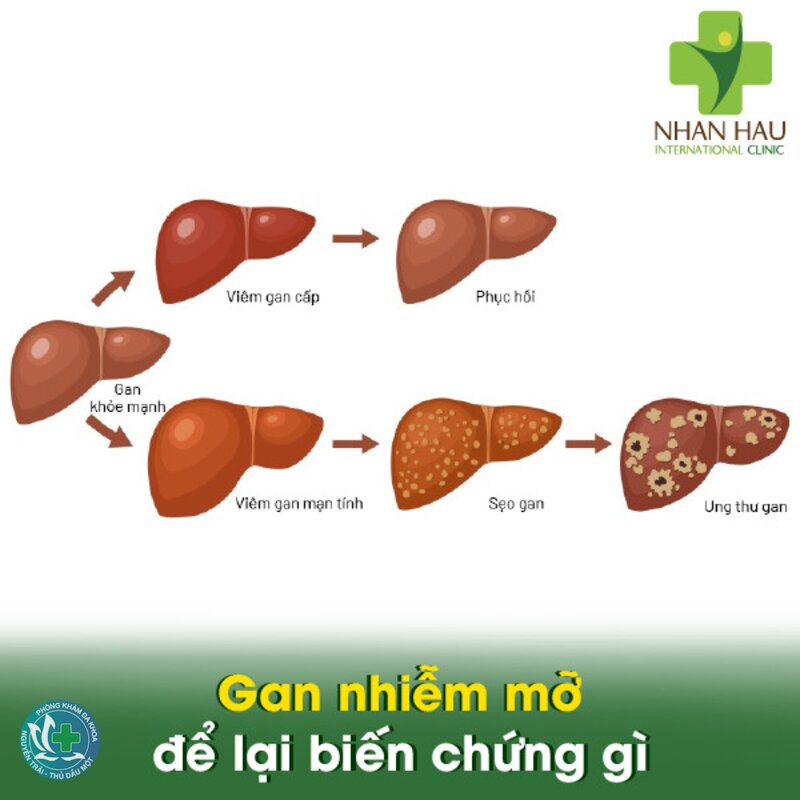 Gan nhiễm mỡ có nguy hiểm không - Dấu hiệu nào cho thấy bệnh nặng? Gan nhiễm mỡ có nguy hiểm không - Dấu hiệu nào cho thấy bệnh nặng?