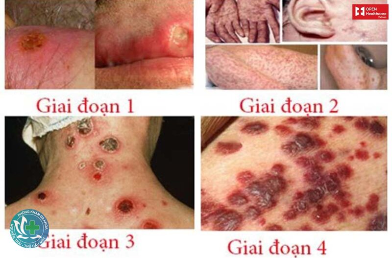giang mai giai đoạn đầu - Dấu hiệu nhận biết giang mai giai đoạn đầu giang mai giai đoạn đầu - Dấu hiệu nhận biết giang mai giai đoạn đầu