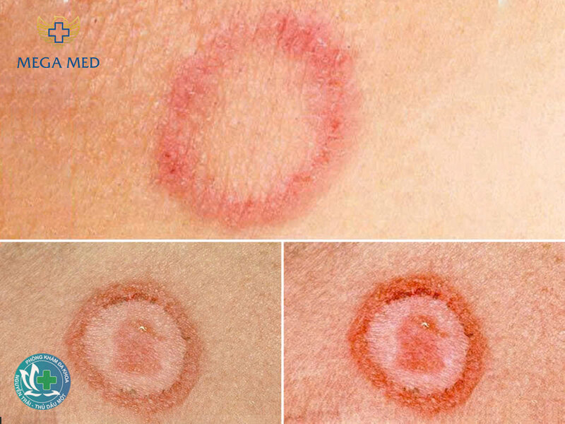 giang mai giai đoạn đầu - Phát ban và tổn thương niêm mạc ở giai đoạn 2 giang mai giai đoạn đầu - Phát ban và tổn thương niêm mạc ở giai đoạn 2