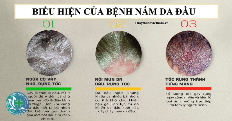 Nấm da đầu - Nấm da đầu biểu hiện như thế nào? Nấm da đầu - Nấm da đầu biểu hiện như thế nào?