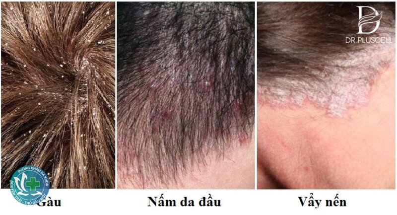 Nấm da đầu - Thuốc uống là điều trị chính Nấm da đầu - Thuốc uống là điều trị chính