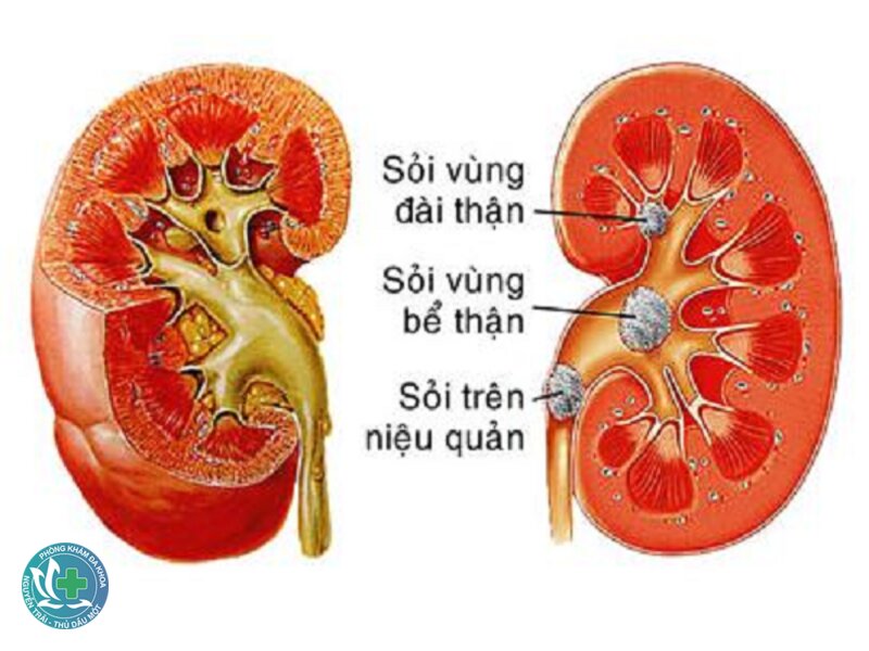 Nguyên nhân sỏi thận - Quá trình tạo sỏi diễn ra thế nào? Nguyên nhân sỏi thận - Quá trình tạo sỏi diễn ra thế nào?