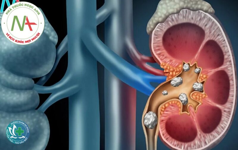 Nguyên nhân sỏi thận - Chế độ ăn tác động ra sao? Nguyên nhân sỏi thận - Chế độ ăn tác động ra sao?