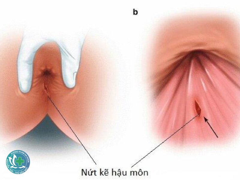 nứt kẽ hậu môn bôi thuốc gì - Thuốc chứa corticoid và các chế phẩm bảo vệ niêm mạc nứt kẽ hậu môn bôi thuốc gì - Thuốc chứa corticoid và các chế phẩm bảo vệ niêm mạc