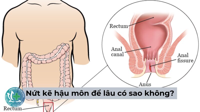 nứt kẽ hậu môn là gì - Táo bón và phân cứng là thủ phạm hàng đầu nứt kẽ hậu môn là gì - Táo bón và phân cứng là thủ phạm hàng đầu