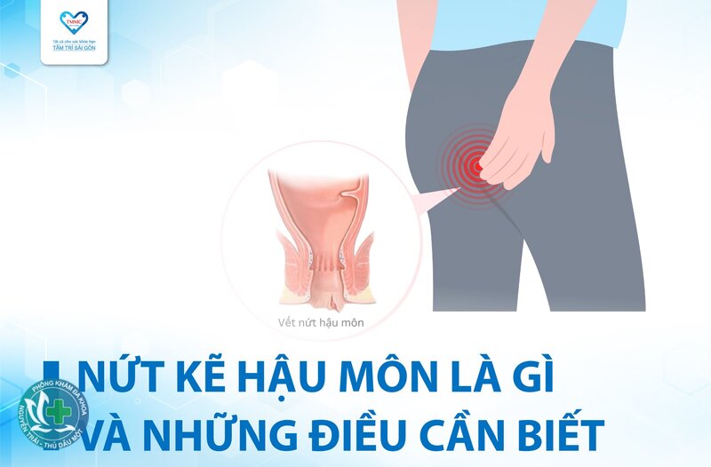 nứt kẽ hậu môn là gì - Các triệu chứng điển hình nứt kẽ hậu môn là gì - Các triệu chứng điển hình