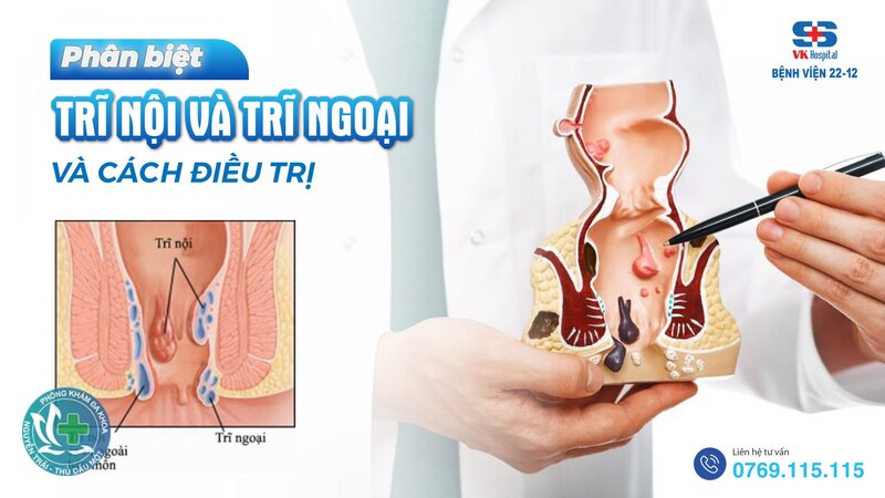 phân biệt trĩ nội và trĩ ngoại - Dấu hiệu thường gặp của trĩ nội