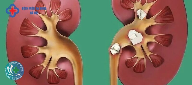 Sỏi thận - Điều trị sỏi thận ra sao?