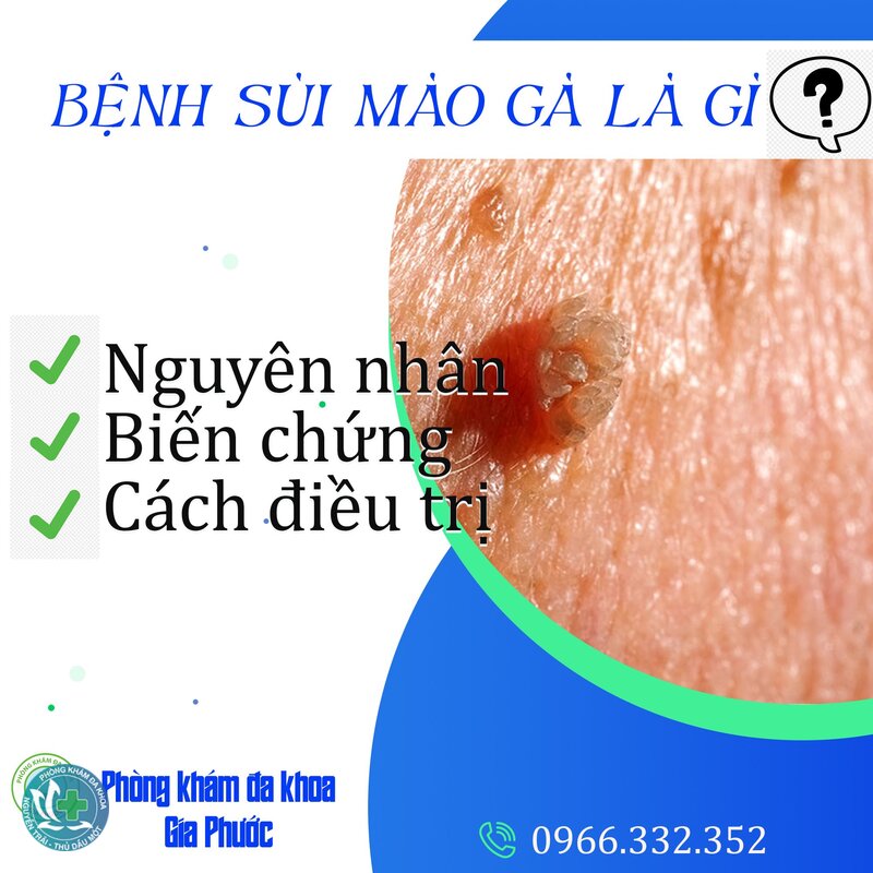 sùi mào gà - Biểu hiện ban đầu