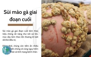 sui mao ga co chua duoc khong 1