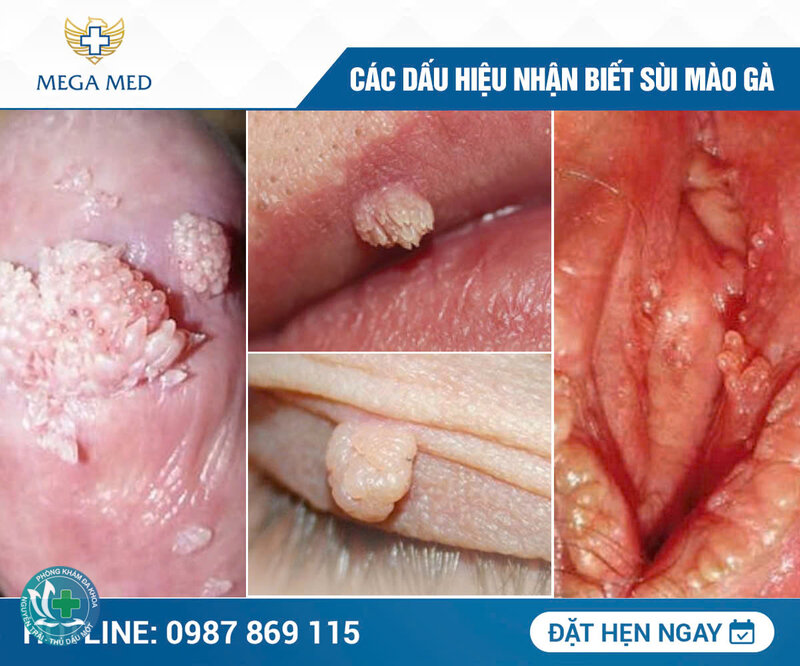 sùi mào gà có chữa được không - Tự thoái lui: có nhưng không đoán trước được sùi mào gà có chữa được không - Tự thoái lui: có nhưng không đoán trước được