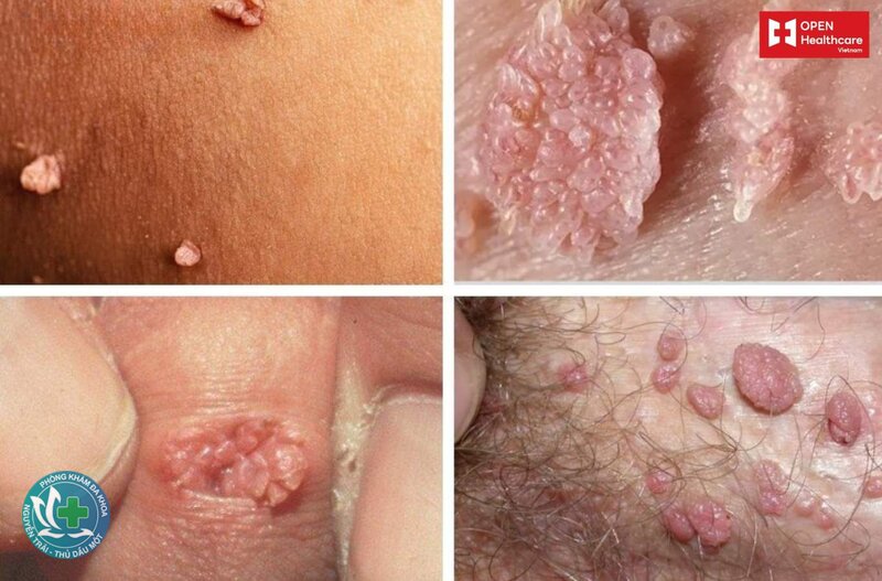 sùi mào gà lây qua đường nào - Tác nhân gây bệnh: virus HPV tuýp nguy cơ thấp sùi mào gà lây qua đường nào - Tác nhân gây bệnh: virus HPV tuýp nguy cơ thấp