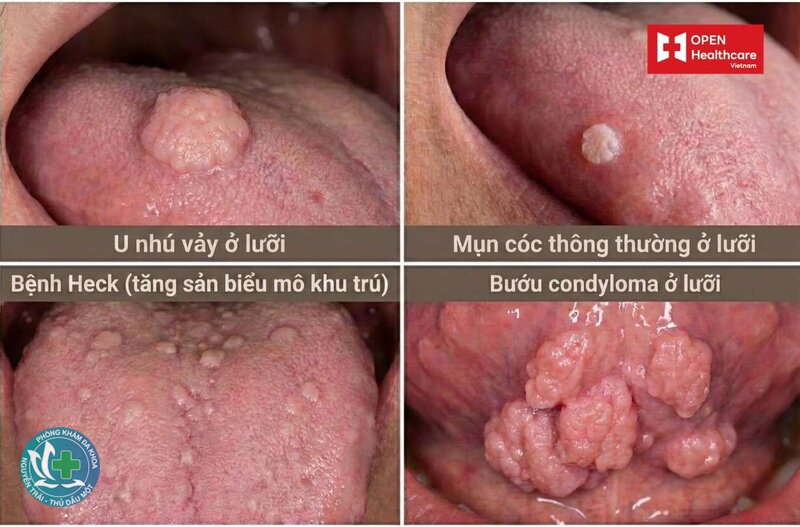 sùi mào gà lây qua đường nào - Các con đường lây truyền chính của sùi mào gà sùi mào gà lây qua đường nào - Các con đường lây truyền chính của sùi mào gà