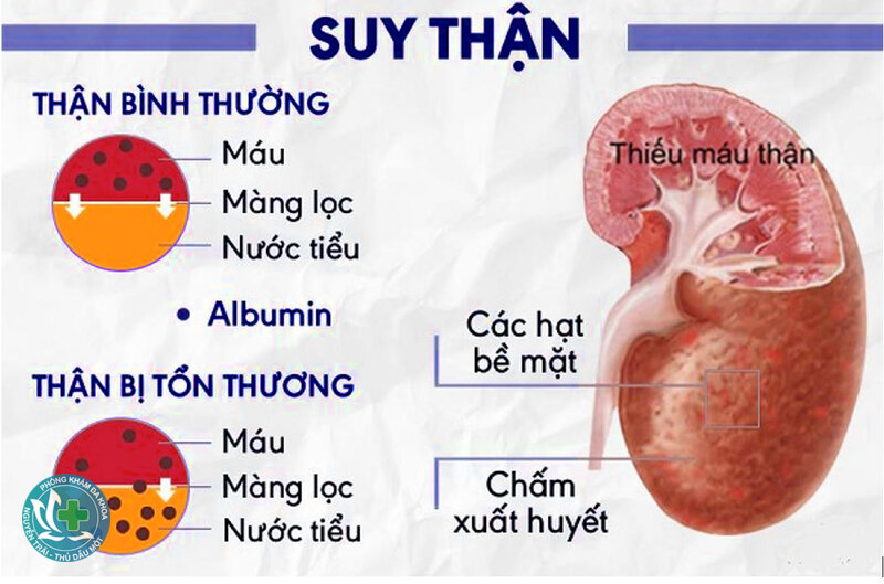 Suy thận - Bác sĩ kiểm tra chức năng thận như thế nào?