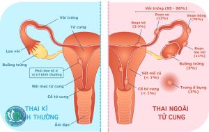 thai ngoai tu cung co dau hieu gi 1