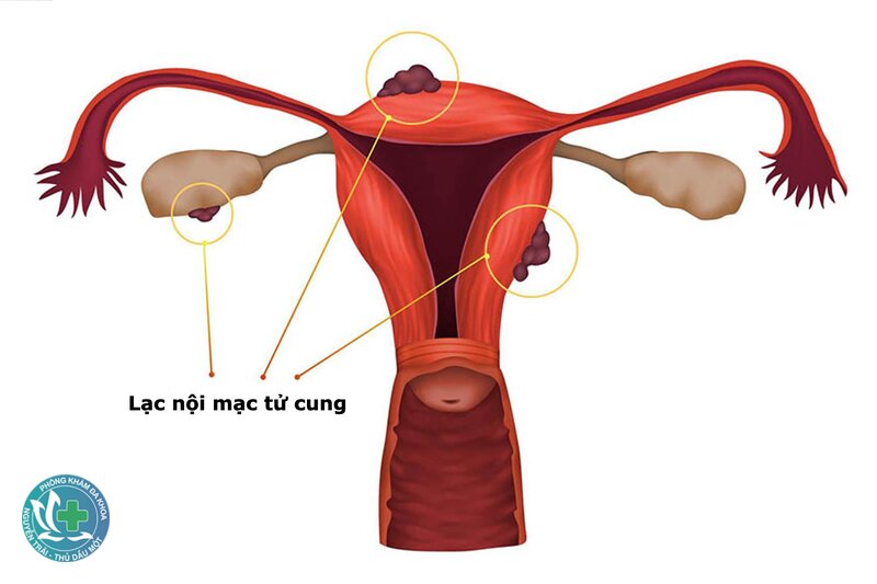 thai ngoài tử cung là gì - Vòi trứng: vị trí thường gặp nhất thai ngoài tử cung là gì - Vòi trứng: vị trí thường gặp nhất
