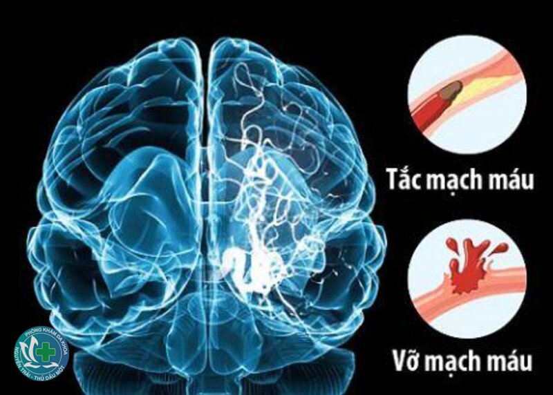 Thiếu máu não - Thiếu máu não xảy ra như thế nào?