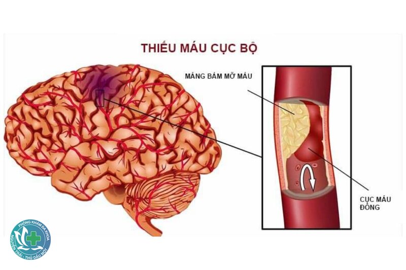 Thiếu máu não - Cần làm gì khi nghi đột quỵ?