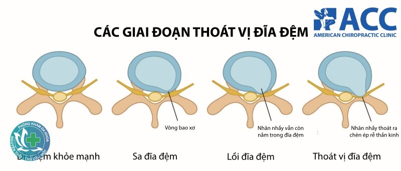 Thoát vị đĩa đệm - Dấu hiệu thoát vị đĩa đệm thắt lưng Thoát vị đĩa đệm - Dấu hiệu thoát vị đĩa đệm thắt lưng