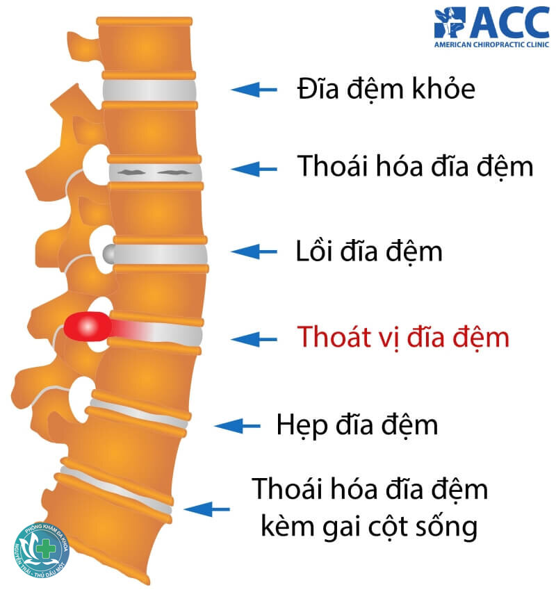 Thoát vị đĩa đệm - Nguyên nhân và yếu tố nguy cơ Thoát vị đĩa đệm - Nguyên nhân và yếu tố nguy cơ