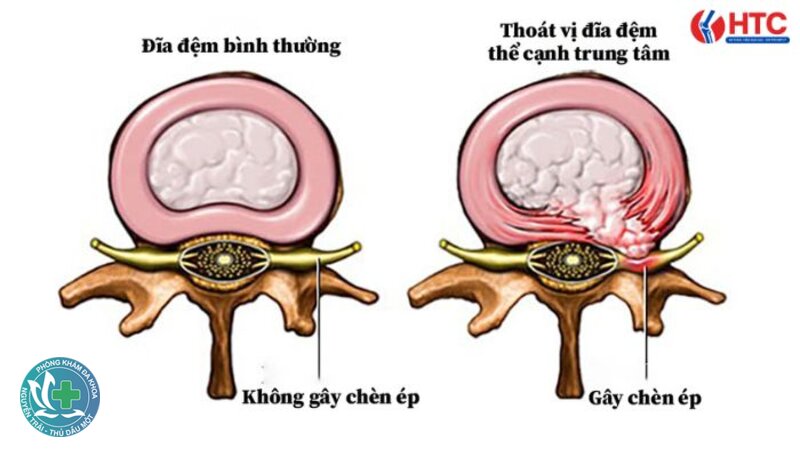 Thoát vị đĩa đệm - Điều trị bảo tồn Thoát vị đĩa đệm - Điều trị bảo tồn