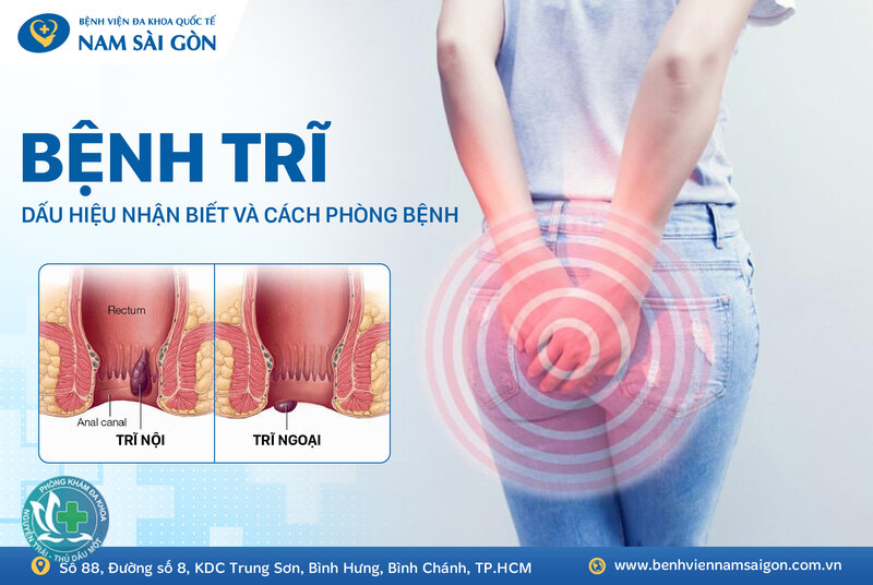 trĩ nội độ 1 - Các cảm giác khác có thể gặp trĩ nội độ 1 - Các cảm giác khác có thể gặp