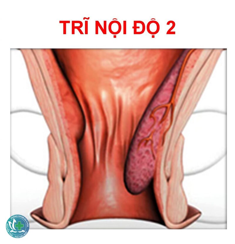 trĩ nội độ 2 - Trĩ nội độ 2 là gì và khác các độ khác ra sao? trĩ nội độ 2 - Trĩ nội độ 2 là gì và khác các độ khác ra sao?