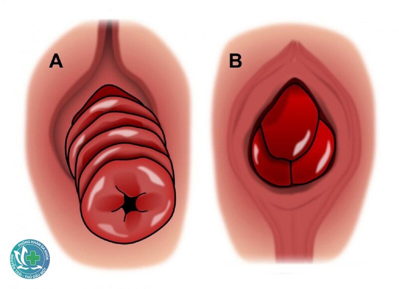 trĩ nội độ 2 - Vì sao búi trĩ còn tự co lên được? trĩ nội độ 2 - Vì sao búi trĩ còn tự co lên được?