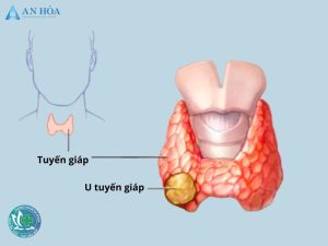 u tuyen giap 1