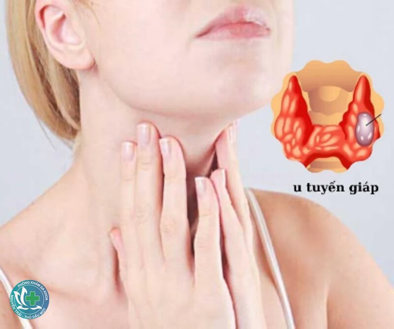 U tuyến giáp - Khi nào chỉ cần theo dõi?