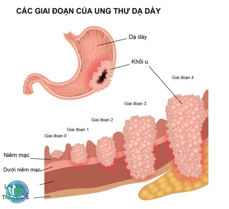 Ung thư dạ dày - Chẩn đoán được thực hiện thế nào? Ung thư dạ dày - Chẩn đoán được thực hiện thế nào?