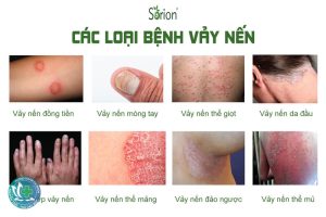 vay nen 1