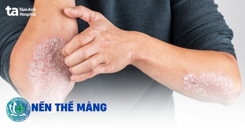 Vảy nến - Dấu hiệu vảy nến Vảy nến - Dấu hiệu vảy nến