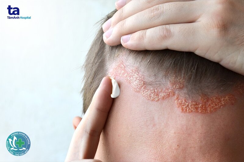 Vảy nến - Nguyên nhân và yếu tố khởi phát Vảy nến - Nguyên nhân và yếu tố khởi phát