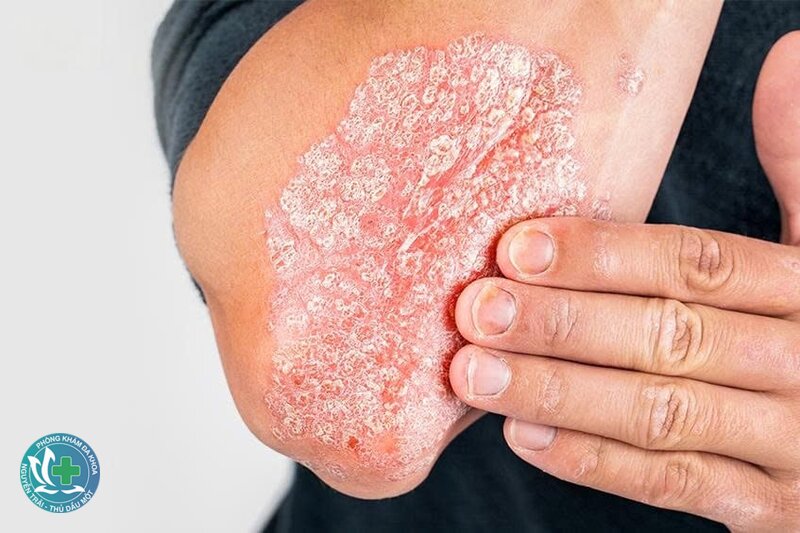 Vảy nến - Bác sĩ chẩn đoán thế nào? Vảy nến - Bác sĩ chẩn đoán thế nào?