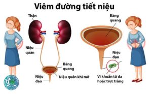 viem duong tiet nieu 1