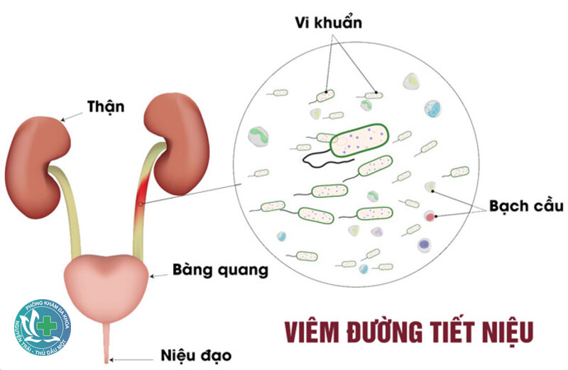 Viêm đường tiết niệu - Điều trị an toàn Viêm đường tiết niệu - Điều trị an toàn