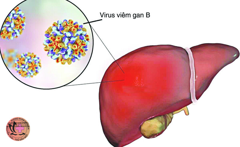 Viêm gan B - Viêm gan B lây qua đường nào? Viêm gan B - Viêm gan B lây qua đường nào?