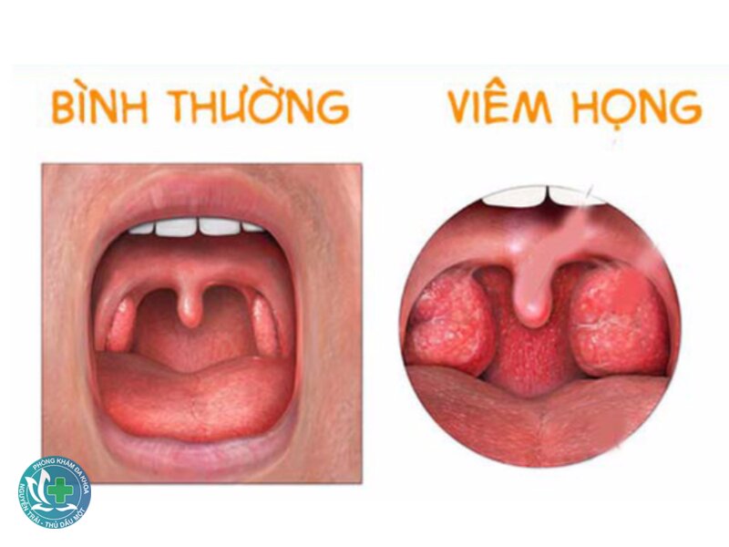 Viêm họng - Viêm họng biểu hiện như thế nào? Viêm họng - Viêm họng biểu hiện như thế nào?