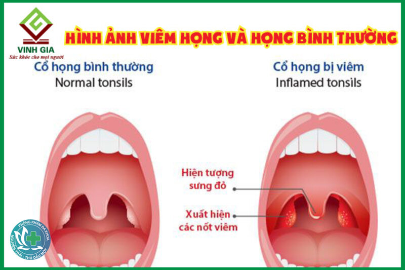 Viêm họng - Khi nào cần xét nghiệm? Viêm họng - Khi nào cần xét nghiệm?
