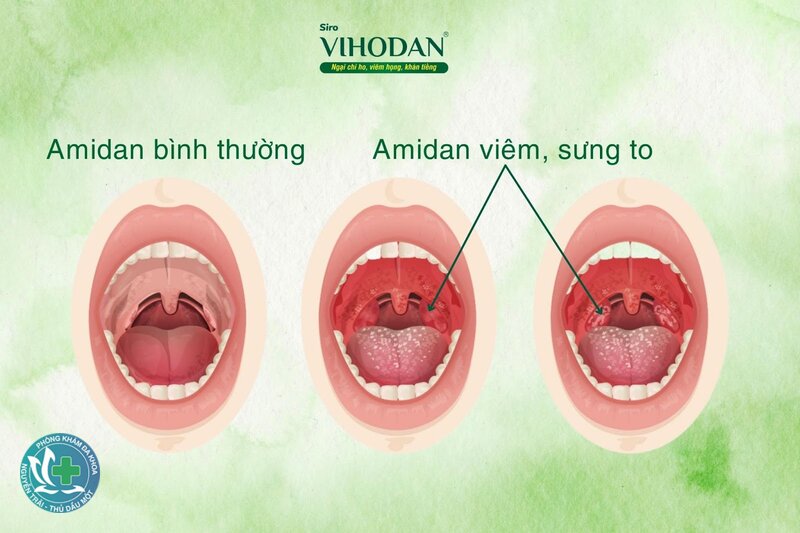 Viêm họng - Kháng sinh có cần thiết không? Viêm họng - Kháng sinh có cần thiết không?
