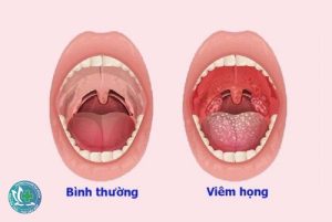 viem hong hat 1