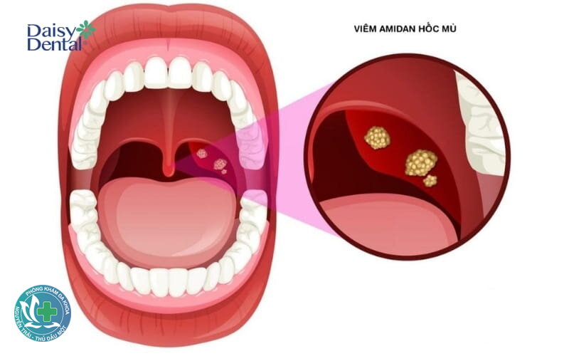 Viêm họng hạt - Triệu chứng thường gặp Viêm họng hạt - Triệu chứng thường gặp