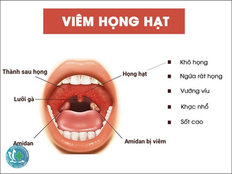 Viêm họng hạt - Giảm kích thích và giữ ẩm Viêm họng hạt - Giảm kích thích và giữ ẩm